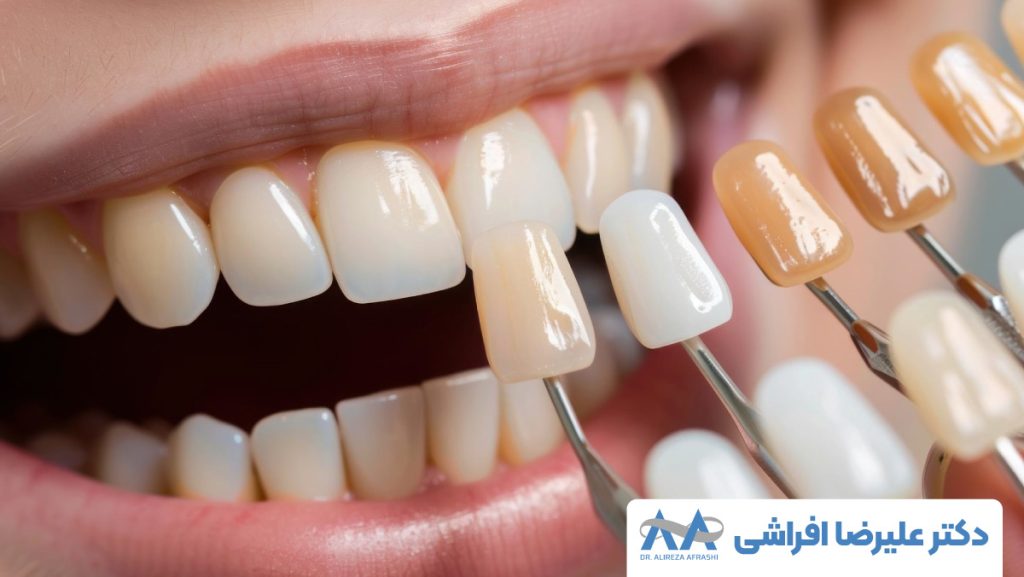 انواع کامپوزیت دندان
