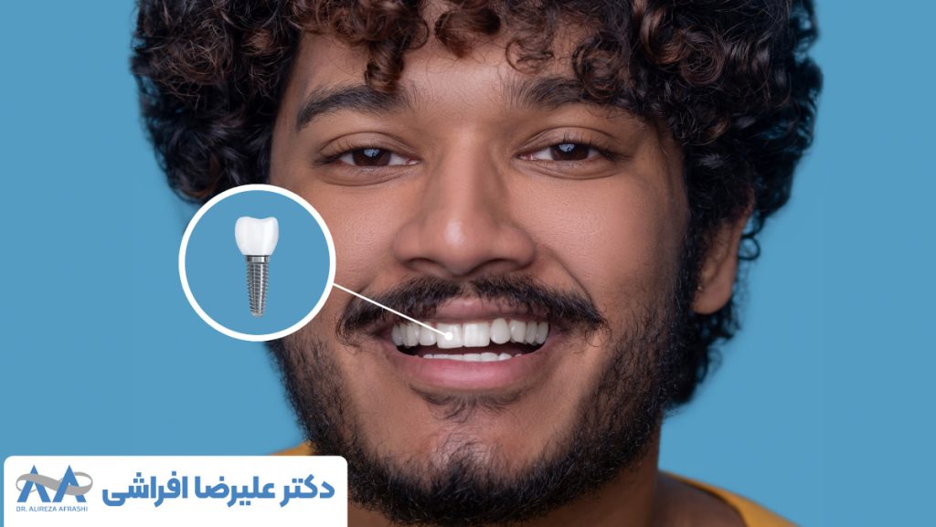 چه عواملی بهترین زمان برای ایمپلنت دندان را مشخص می‌کنند؟
