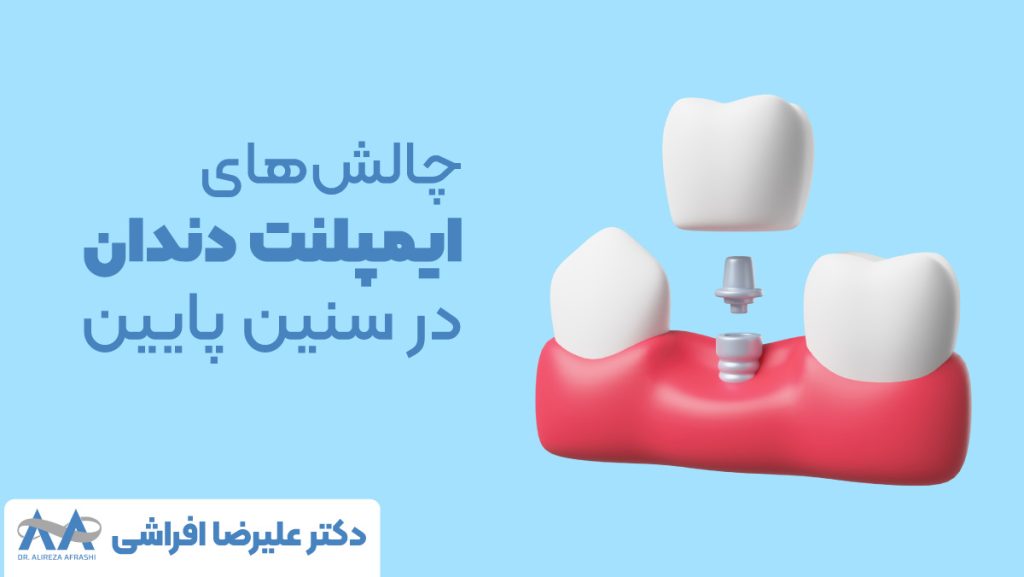 چالش‌های ایمپلنت دندان در سنین پایین