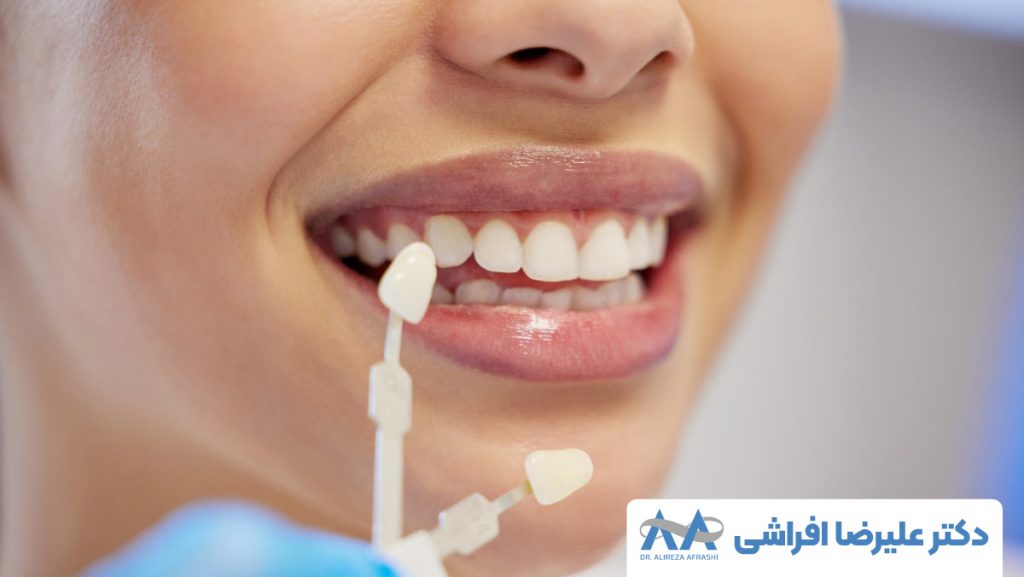 چگونه از آسیب لمینت دندان جلوگیری کنیم؟