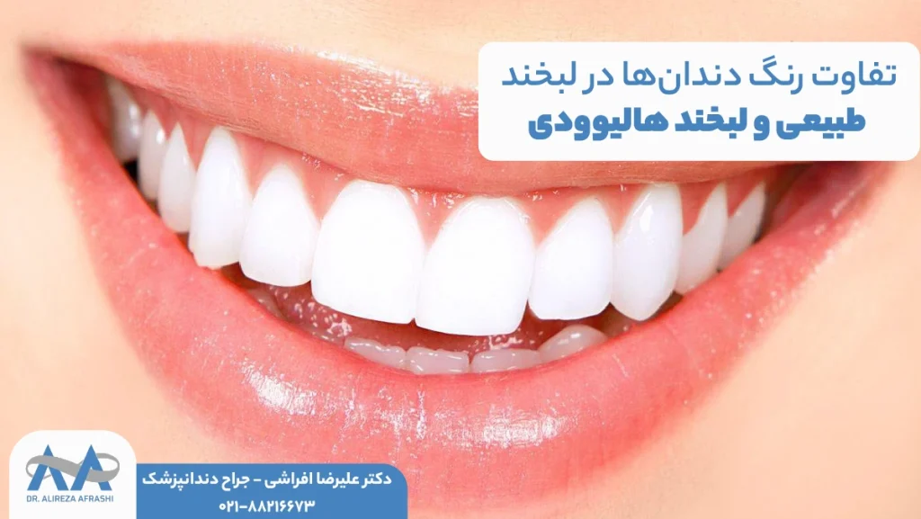 تفاوت رنگ دندانها در لبخند طبیعی و لبخند هالیوودی