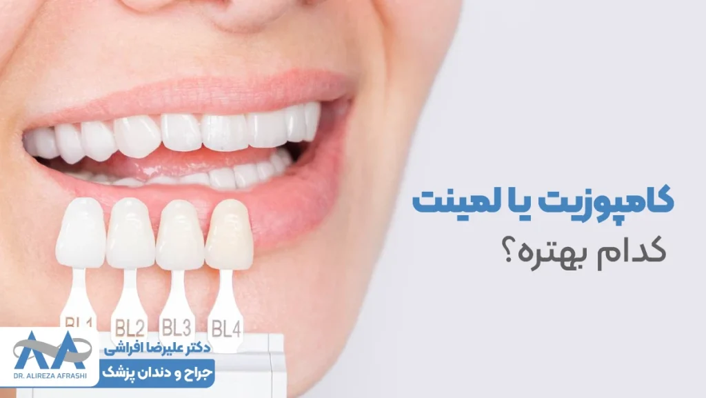 کامپوزیت یا لمینت | کدام بهتره؟